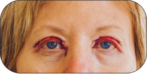 Procedimentos palpebrais Dr Márcio Isabella