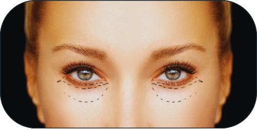 Procedimentos palpebrais Dr Márcio Isabella