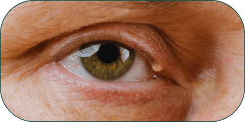 Procedimentos palpebrais Dr Márcio Isabella