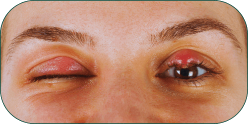 Procedimentos palpebrais Dr Márcio Isabella